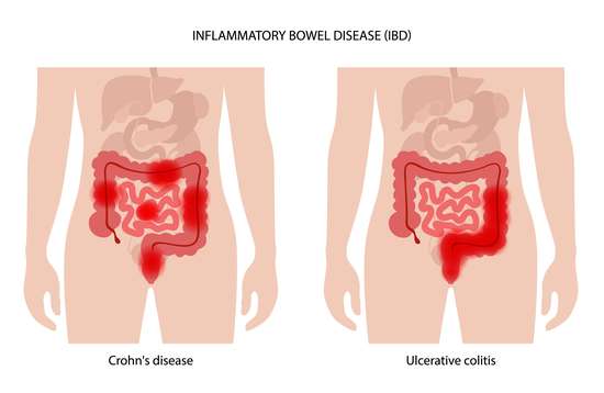 What to Eat When You Have Inflammatory Bowel Disease?
